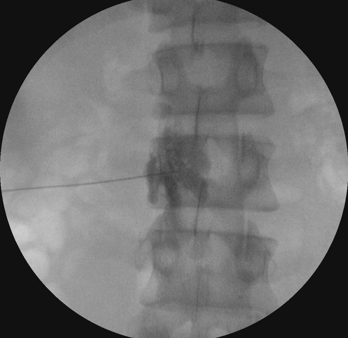 요부 교감신경 차단술 C-arm 영상